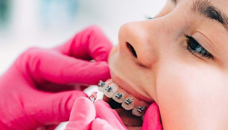 Ortodoncia para niños/as: ¿Brackets o bioactivadores? ¿Cuál es la mejor opción?